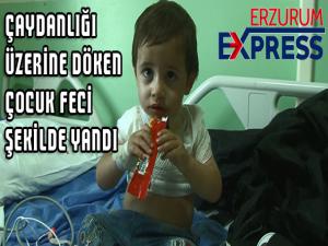 Çaydanlığı üzerine döken çocuk feci şekilde yandı