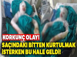 Liseli kız bitlenen saçlarını benzinle yıkamak isterken kendini yaktı 