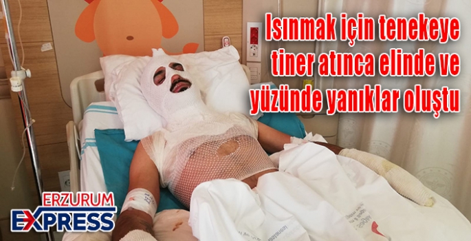  Isınmak için tenekeye tiner atınca elinde ve yüzünde yanıklar oluştu