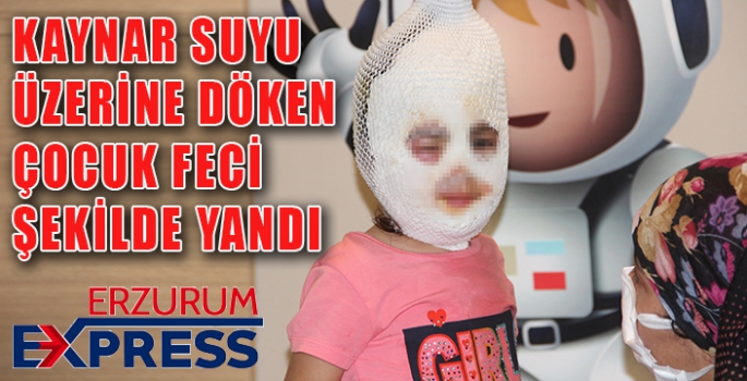 Kaynar suyu üzerine döken çocuk feci şekilde yandı