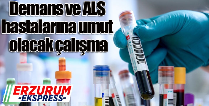 Demans ve ALS hastalarına umut olacak çalışma